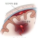 뇌출혈 전조 및 정보원인 무엇일까? 이미지