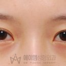 에이엠성형외과의원 네이버블로그