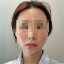 글로우미 | 강남피부과 미글로우 리프팅 후기, 온다와 차이 직접 받아본 솔직 리뷰