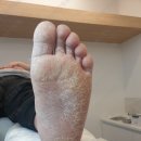 세상편한발톱