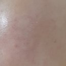 이화샘피부과의원 | 일산피부과 코레지 리프팅