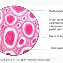 난소암 점액성 3기 진단을 받았는데 향후 치료 방향과 참고 사항 이미지