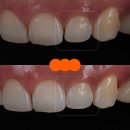 시온의빛치과교정과치과의원 | 서초구치과 치아 사이 삭제 부작용과 치료법