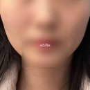 신비라인의원 | 땅콩형 얼굴 탈출기! 쥬베룩 볼륨 1회차 리얼 후기, 스컬트라 고민(feat. 예신의 길)