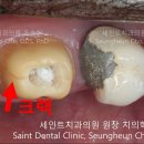 세인트치과 네이버블로그