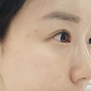 강남피부관리, 강남플라즈마 불레부뷰티 후기