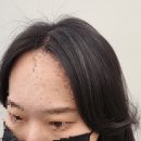 자연헤어샾 | 산후 탈모로 비어버린 앞머리..자연스럽게 채운 리얼 헤어증모술 후기