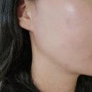 점빼고 패치 사용 컴포케어 팝 여드름 패치 관리한 후기
