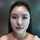 리프업의원 | 내시경 이마거상후기 변화 모습 (거상경력 20년차 원장)