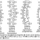 Scoliosis의 원인과 치료 이미지