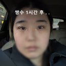 건안구조ENG | 짝눈 매몰 절개 눈매교정 쌍수 일주일 후기 중증근무력증 안구형 쌍수