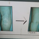 현대항분하지외과의원 네이버블로그