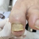 꽁쭈발관리 앞 횡단보도 | 신설동역 발톱무좀, 내성발톱, 발각질, 문제성발관리 전문샵 후기 레푸스청량리점