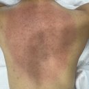 만의약초방 | [청주 올스킨] 청주 등드름 관리, 등 여드름 약초필링 후기, 신부관리 에스테틱