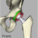 [고관절인공관절] 고관절인공관절의 필요성 이미지