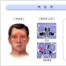 축농증 비염치료~~ 이미지