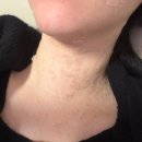 한화장반점 | 김해 편평사마귀 제거 후기: CO2 레이저 시술 과정부터 주의사항 및 관리법 공유