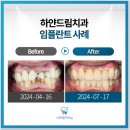 하얀드림치과의원조치원치과, "이 정도는 괜찮겠지" 했다가 생긴 일