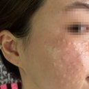 오오피부과의원 | 강남 압구정 피부과 리쥬란 힐러 가격 이벤트 내돈내산 찐후기, 30대 피부 우울증 극복 (비용, 통증...