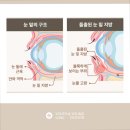 도곡유스앤영의원 | 20대 눈밑지방제거 내돈내산 후기