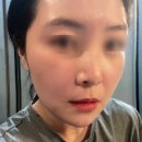 둔산동 볼뉴머 얼굴주름리프팅 신상 경험 후기