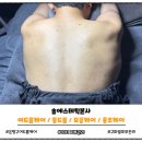 모광 | 구파발 피부관리 추천: 은평구 등드름케어 바디여드름흉터관리 피부샵 솔에스테틱본사