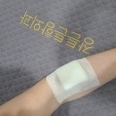 장튼튼항외과의원 | 표피낭종 수술 김포 장튼튼항외과의원 다녀온 후기