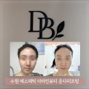 더마인 | 30대 40대 심부볼 팔자주름 고민 수원 인계동 피부관리 더마인뷰티 온다리프팅 10만줄 후기