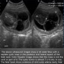 Cystic hygroma 이미지