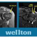 #어깨통증!!, 어깨회전근개파열?? 이미지