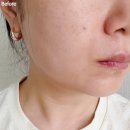 에센스피부과의원 | 니들샷 에센스 자극 없었던 이유? 닥터제이에스케이 PDRN 모공 에센스 리얼 후기