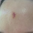 인제한의원 | 수두흉터 지우려다 더크게 생긴 레이저흉터..! 로담한의원 새살침으로 채워보기(1회차)