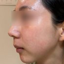 떼보야식당 | [여드름식단]밀가루,유제품,설탕 3주 끊기_3주차 후기