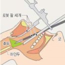 목소리 보존하고 합병증 없는 하인두암 로봇 수술 도입 이미지