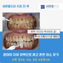 누런 치아 고민 끝! 부천 중동 전문가 치아 미백으로 밝고 환한 미소 찾기