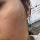 맨앤네이처 성형외과의원 | [내돈내산] 에이비성형외과 리쥬란 4cc 맨정신으로 맞은 후기 (한달차 사진 포함)