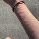 면역력 저하 두드러기 약 병원 선택 (내과? 피부과?)