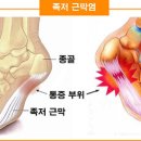 발뒤꿈치 통증 증후군- 족저근막염 증상, 원인 및 치료 이미지