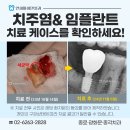 어금니 치주염 방치, 발치 즉시 임플란트 후기 종로치과