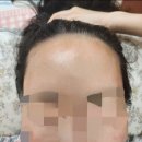 모엠의원 | 광고절대X) 내돈내산 헤어라인 모발이식 찐후기/ 마빡이에서 이마미인이 되어보자...💗
