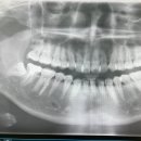 강릉원주대학교치과병원 | 매복사랑니 발치 후기 (운전, 비용, 실비, 통증, 붓기...우울.. feat. 강릉원주대학교 치과대학(강릉치대)