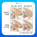 An치과기공소 | 호치민 2군 빅스 치과 13년차 치위생사의 턱관절 스프린트 후기ㅣ호치민 턱관절진료