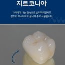 치아에 난 구멍 방치했다가 신경치료 받은후기 이미지