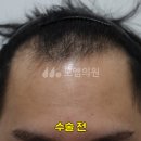 모엠의원 후기 비절개 투블럭 모발이식 3800모 1년 후 (남자/M자탈모+C/전지훈원장) 이미지