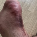 윈윈정형외과의원 | 청주 아킬레스건 수술 후 8주차 족부전문병원 윈윈정형외과