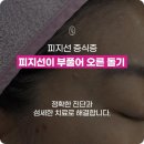 대유한의원 | 원주피지선증식증 여드름인 줄 알고 짰다가는 큰일 납니다