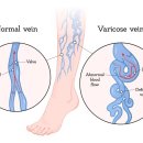 하지 정맥류 이미지