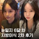 [내돈내산]얼굴 지방이식 2차+눈밑지 6달 차 후기(짝짝이/여우눈/과생착 등등)