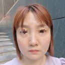 강남역피부과 스킨무통보톡스 3cc 후기) 안 아픈 스킨보톡스 찾는다면 베르나의원