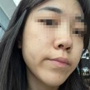 안양제일약국 | 안양 편평사마귀제거 2주차 후기 시술부터 리터치 회복까지 찐후기